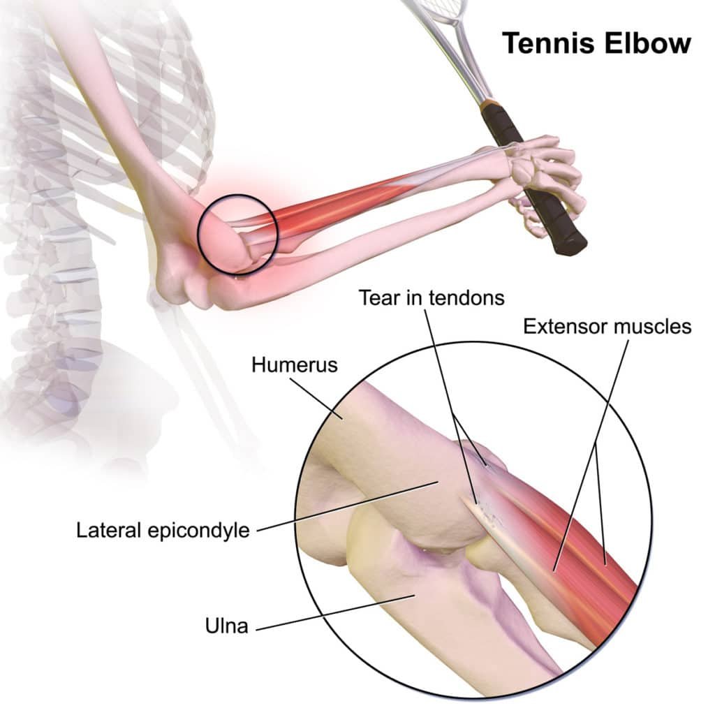 diagram of pickleball (tennis) elbow